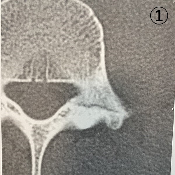 レントゲン写真